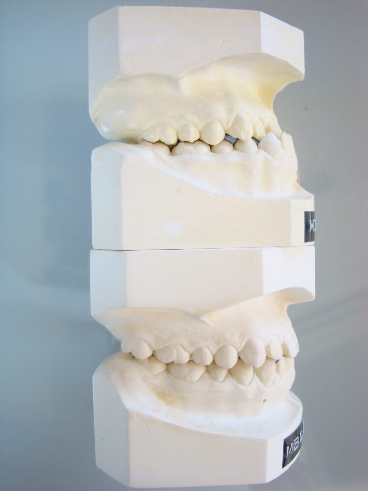 矯正歯科専門医が行う医療である矯正治療対3Dプリンタでこしらえた食えない饅頭=マウスピース矯正