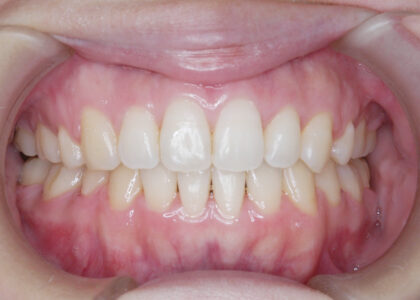 インビザラインやめたほうがいい１０の理由= 一矯正歯科専門医の意見8)専門医会の調査から一般歯科で治っていると言えるのはおよそ１０人にひとりかふたり