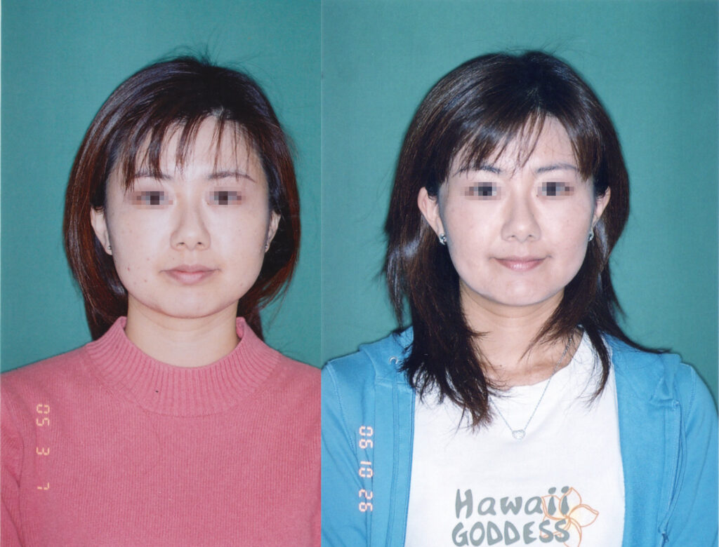 「非抜歯での矯正では口も顔もでかくなる」