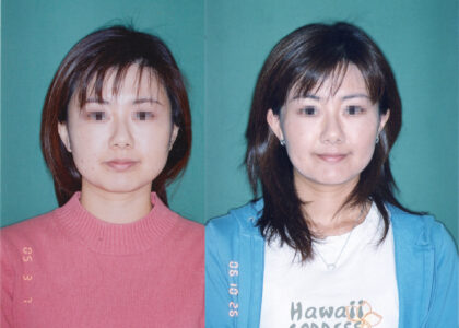 「非抜歯での矯正では口も顔もでかくなる」