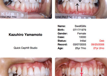 「矯正歯科専門医による矯正治療結果＝正中線の一致・インターディジテーションの確立」