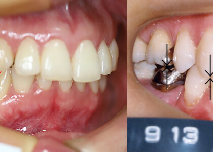 「NG矯正vs矯正歯科専門医による価値ある本当の矯正治療」