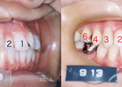 「GP= 一般歯科医院でのすべて非抜歯の矯正治療の被害」