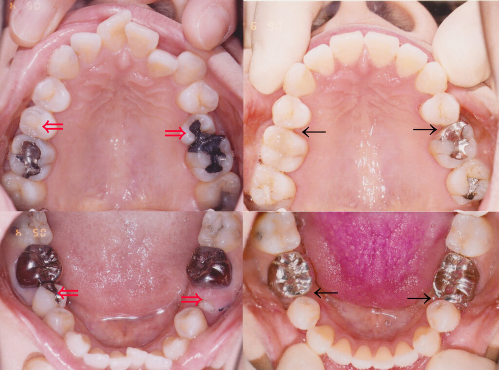 「セファロ分析 : 矯正歯科専門医による抜歯非抜歯の判定」