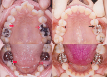 「セファロ分析 : 矯正歯科専門医による抜歯非抜歯の判定」