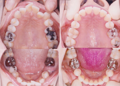 「矯正歯科専門医による抜歯を伴うワイヤー矯正による矯正治療前後の変化」