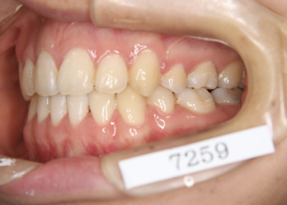 「ひとはまだ本当の矯正治療を知らない！＝矯正歯科鎌倉 dentofacoで矯正歯科専門医による価値ある本当の矯正治療で改善可能な点　４）歯が長持ちする＝予防歯科学的意義」