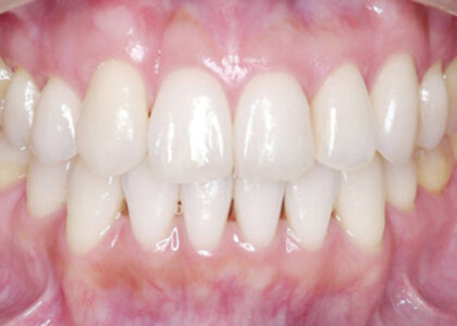 「ひとはまだ本当の矯正治療を知らない！＝矯正歯科鎌倉 dentofacoで矯正歯科専門医による価値ある本当の矯正治療で改善可能な点６）歯並びが良くなる＝審美的意義」