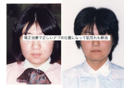 「ひとはまだ本当の矯正治療を知らない！＝矯正歯科鎌倉 dentofacoで矯正歯科専門医による価値ある本当の矯正治療で改善可能な点8) 肌荒れが治る＝皮膚科学的意義」