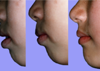 12) 矯正歯科専門医による矯正治療で口が閉まるようになり鼻呼吸がしやすくなる