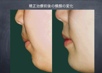 “ひとの顔の美しさは前顔よりも横顔において現れしかもその下1/3が美の重要な決定要素である”