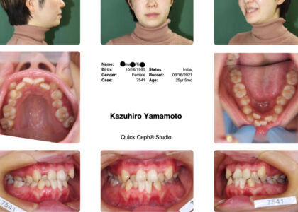 マウスピースで３年半何も起こらなかったサイレント矯正