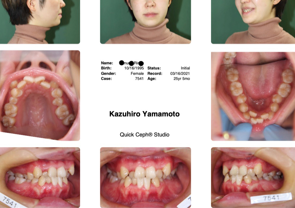 マウスピースで３年半何も起こらなかったサイレント矯正