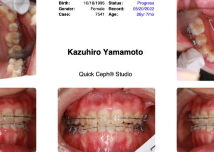 マウスピースで３年半何も起こらなかったサイレント矯正２