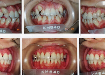1.昨今のマウスピース矯正の蔓延を矯正歯科医が憂う