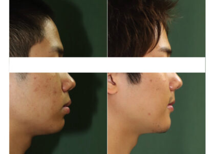 きりりと凛々しい口元に/抜歯を視野に入れた矯正歯科専門医による矯正治療