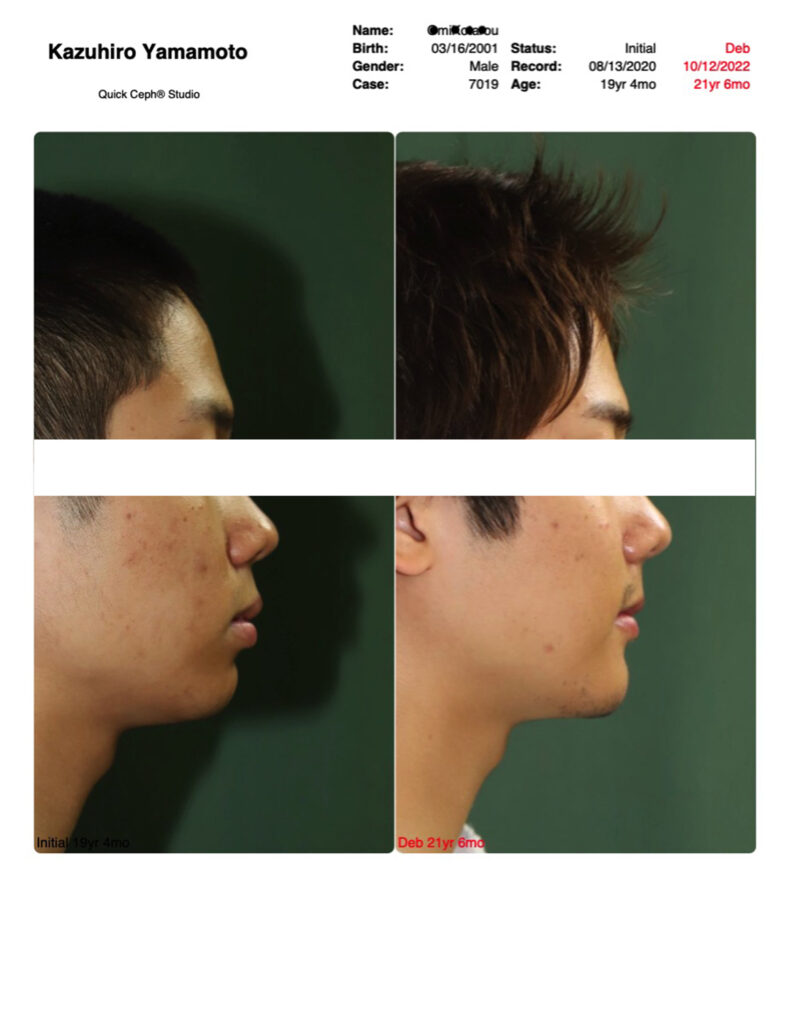 きりりと凛々しい口元に/抜歯を視野に入れた矯正歯科専門医による矯正治療