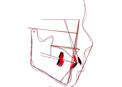 きりりと凛々しい口元に/抜歯を視野に入れたワイヤーによる矯正治療前後セファロ重ね合わせ