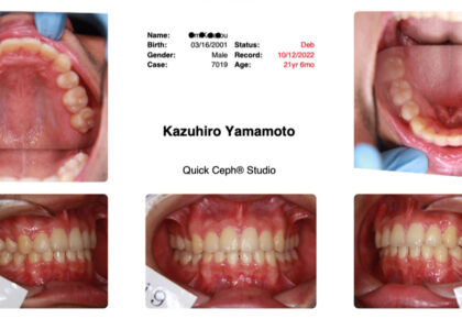 きりりと凛々しい口元に/抜歯を視野に入れたワイヤーによる矯正治療結果