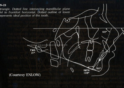 キチンと治る矯正治療の診断（セファロによる抜歯・非抜歯の判断基準）