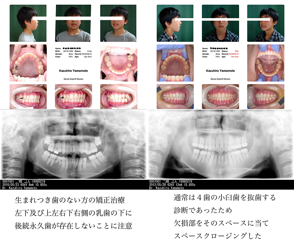 矯正歯科専門医ができる先天的に一部の歯がない方達の矯正治療