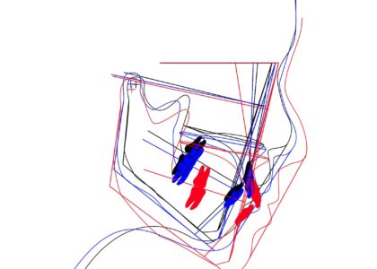 顎顔面整形歯科治療で顔の骨格は作り変え可能