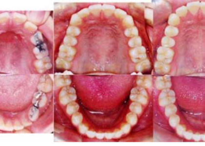小児矯正治療の相談・資料採取・診断料が保険適用になりました