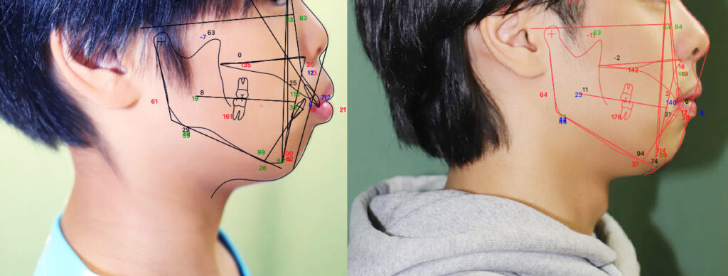 日本歯科専門医機構認定矯正歯科専門医が行う小児矯正2