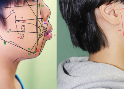 日本歯科専門医機構認定矯正歯科専門医が行う小児矯正2