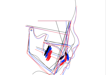 それでは矯正歯科専門医と一般歯科医の小児矯正治療のどこが違うのでしょうか？