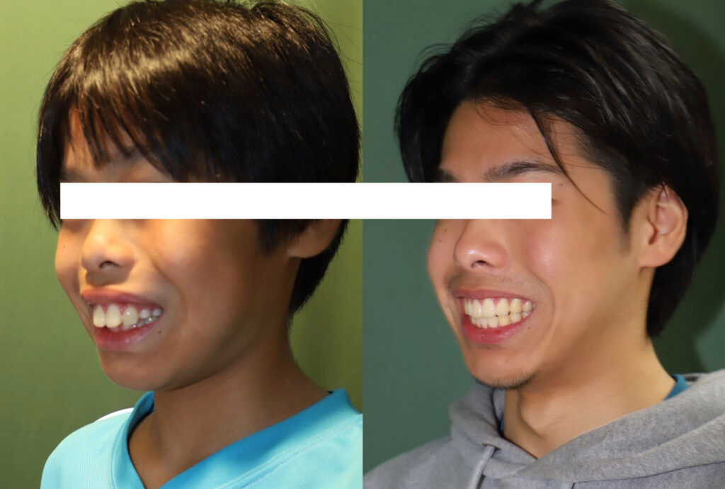 日本歯科専門医機構認定矯正歯科専門医が行う小児矯正