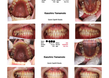 上顎前歯部に叢生（デコボコ）を伴う反対咬合・下顎前突症成人症例