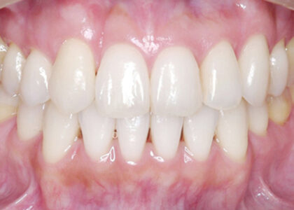 矯正治療計画上ない歯を抜歯すべき歯の代わりとすることがあります！