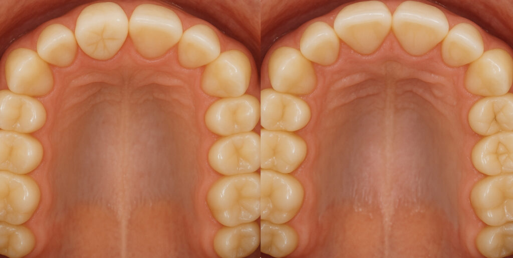 第84回日本矯正歯科学会  臨床セミナーの演題＝”歯の移植は次世代矯正歯科の標準治療になりうるか”