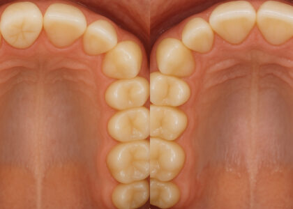 第84回日本矯正歯科学会  臨床セミナーの演題＝”歯の移植は次世代矯正歯科の標準治療になりうるか”