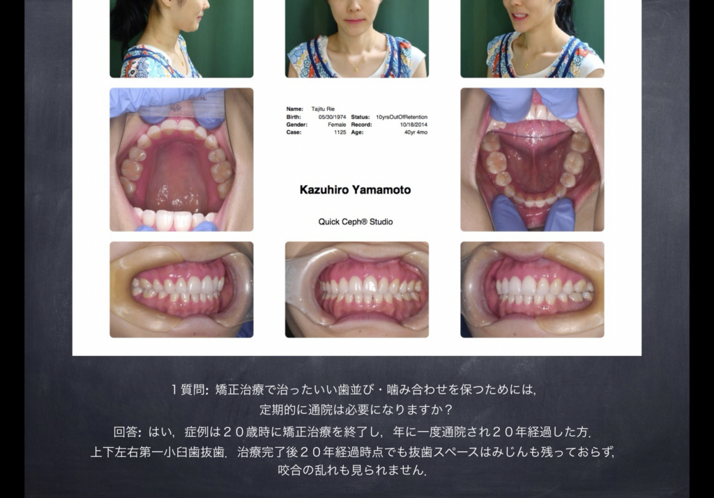 海外から転院後カマクラデントフェイシャルオーソピディクスで矯正治療完治 ２０年安定症例