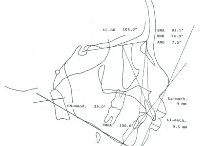 「子どもの矯正治療/ミニマムアクチベータ治用術前のセファロ分析」