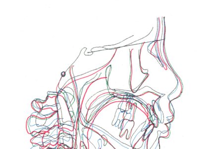 「カマクラデントフェイシャルオーソピディクスオリジナルの取り外しの効くミニマムアクチベータの治療結果」