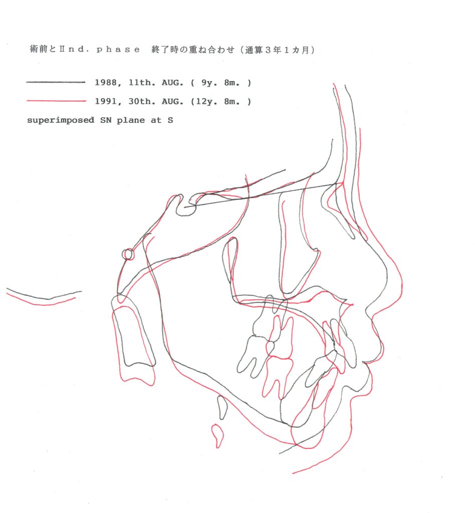 カマクラデントフェイシャルオーソピディクス創案のミニマムアクチベータ11カ月使用後の矯正治療効果