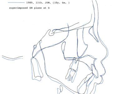 「カマクラデントフェイシャルオーソピディクス　オリジナルの取り外しの効くミニマムアクチベータの整形効果」
