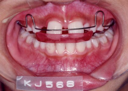 「子どもの矯正治療」