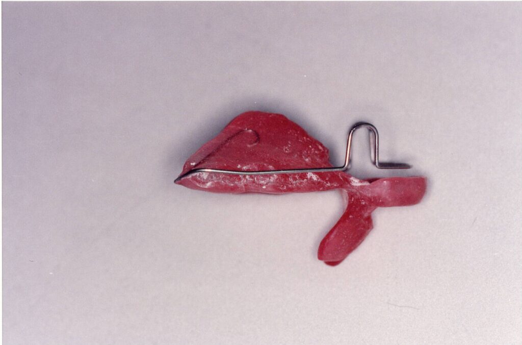 カマクラデントフェイシャルオーソピディクスにて創案発展してきた取り外しの効くマウスピース型矯正装置ミニマムアクチベータ