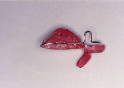 当院で創案された取り外しの効くマウスピース型整形装置＝ミニマムアクチベータの歴史