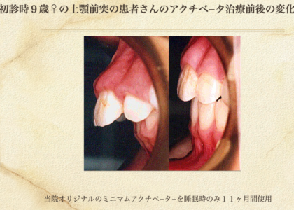 「子どものための矯正治療」